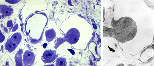Immigration of two melanocytes into a lymphatic capillary
